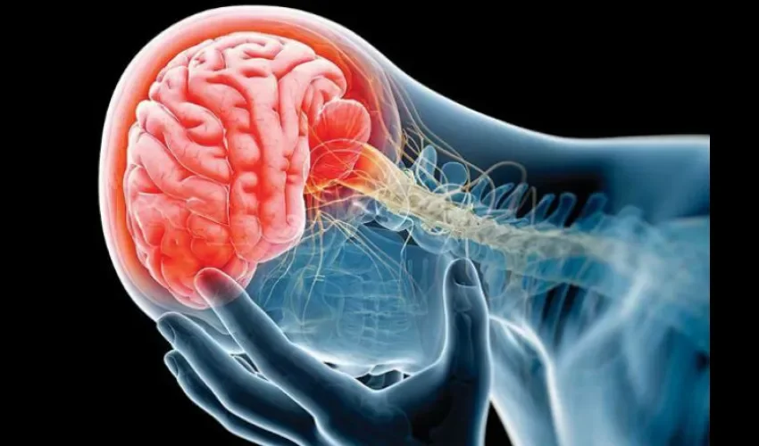 Foto ilustrativa de los problemas cerebro vasculares. Cortesía. 